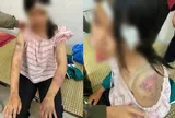 Thông tin mới vụ bé gái 13 tuổi bị tra khảo, đánh đập dã man, người chi chít vết thương