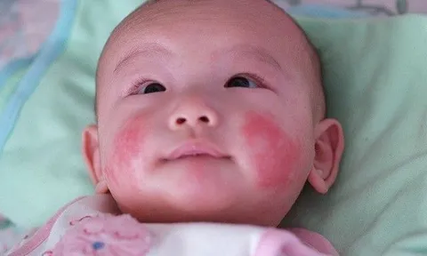 Làm sao để xóa vết bớt trên mặt trẻ?