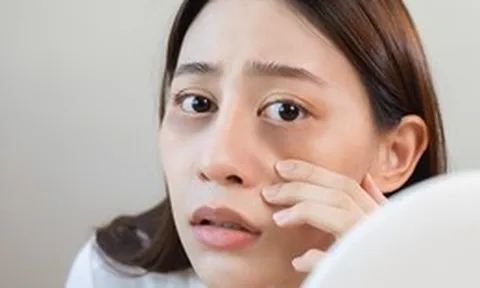 Quầng thâm dưới mắt – Cảnh báo thiếu hụt vitamin và khoáng chất bạn không nên bỏ qua