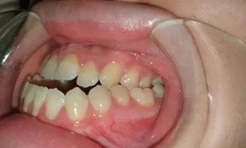 Điều trị móm (khớp cắn ngược) do xương hàm