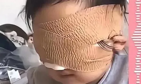 Bé gái 6 tuổi mất cả 2 mắt vì thứ nhiều bố mẹ vẫn cho con chơi mỗi ngày