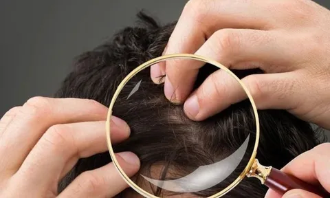 Không phải cứ có tóc bạc là lão hóa: Có 2 loại tóc trắng này trên đầu thì bạn cần đi khám sớm xem có mắc bệnh nào không