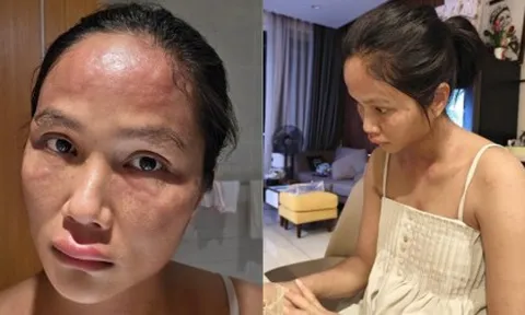 Gương mặt biến dạng sau sinh của H'Hen Niê