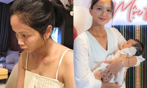 Chi nửa tỷ/tháng để ở cữ, H'Hen Niê nay "biến dạng" ngoại hình vì bệnh lạ sau sinh, chỉ 1/10 người gặp phải