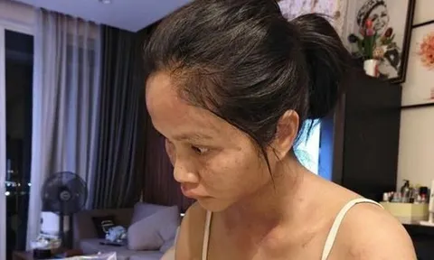 Gương mặt H'Hen Niê biến dạng, trấn an fan bớt lo