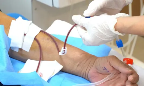 Nhiều người trẻ suy thận do biến chứng từ viêm cầu thận IgA 0