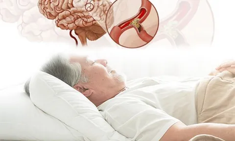 Cảnh báo nguy cơ đột tử do ngủ ngáy kéo dài 0