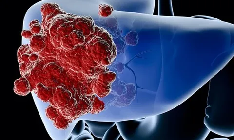 Bất ngờ phát hiện ung thư gan giai đoạn muộn từ 3 dấu hiệu lạ ở bụng