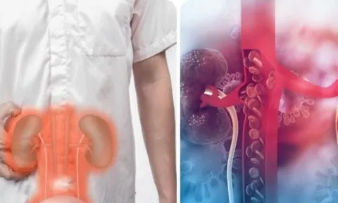 Suy thận có dấu hiệu gì?