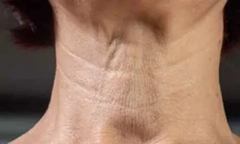 4 bài tập đơn giản xóa nếp nhăn, làm săn chắc vùng cổ tự nhiên tại nhà