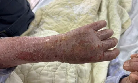 Người phụ nữ bị ngứa dữ dội đến mức “ảo giác có sâu bò”: Nguyên nhân gây sốc từ thói quen nhiều người Việt vẫn làm