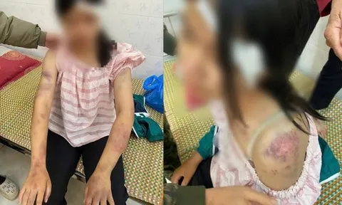 Thông tin mới vụ bé gái 13 tuổi bị tra khảo, đánh đập dã man, người chi chít vết thương