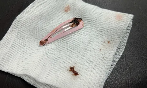 Gắp kẹp tóc dài 7cm khỏi dạ dày bé gái 6 tuổi 0