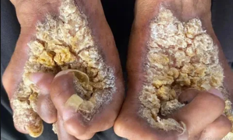 Da xù xì như mọc nấm vì hội chứng lạ 0