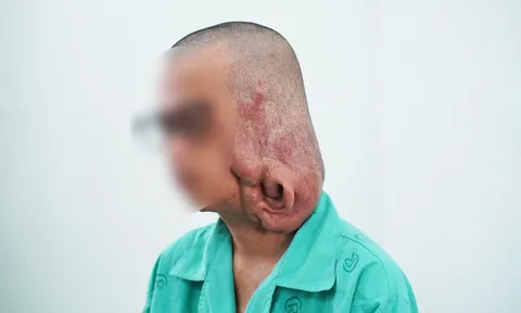 Phẫu thuật cắt bỏ khối u sợi thần kinh gần 1kg gây biến dạng mặt 0