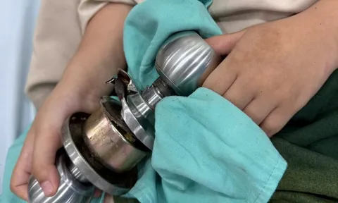 Bé trai vào viện cấp cứu cùng ổ khoa dính chặt ngón tay