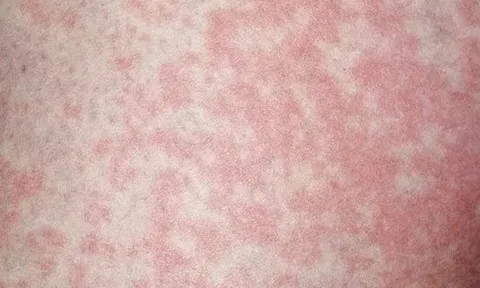 Người đàn ông nhiễm nấm vùng kín vì thói quen nhiều người làm với đồ lót của mình