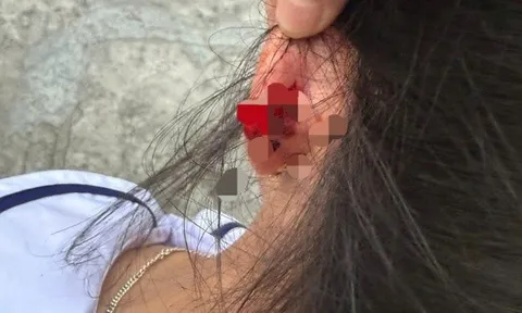 Xác minh vụ cô giáo ở Phú Quốc nhéo tai học sinh lớp 1 đến chảy máu