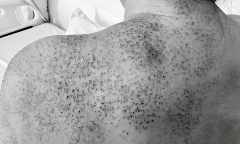 Người phụ nữ nhập viện cấp cứu sau khi chích lể, giác hơi