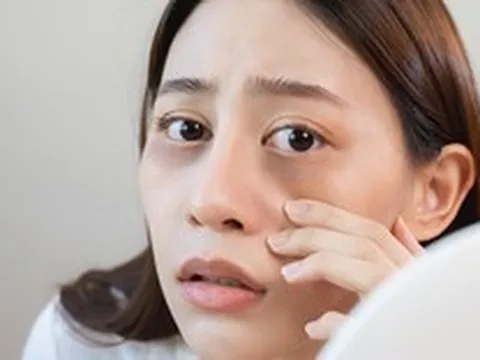Quầng thâm dưới mắt – Cảnh báo thiếu hụt chất dinh dưỡng nào?
