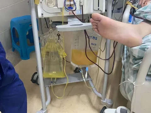 Chàng trai 19 tuổi máu đục như sữa, suy đa tạng nguy kịch vì 2 kiểu LƯỜI người trẻ thường mắc phải