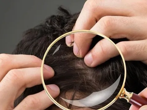 Không phải cứ có tóc bạc là lão hóa: Có 2 loại tóc trắng này trên đầu thì bạn cần đi khám sớm xem có mắc bệnh nào không