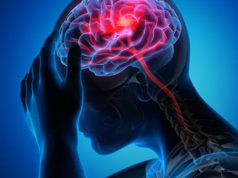Hơn 99% các cơn đột quỵ và nhồi máu cơ tim liên quan 4 điều này