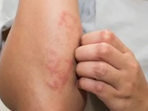 5 nhóm thực phẩm nên ăn để giảm ngứa da