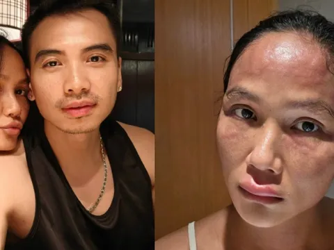 Hoa hậu H'Hen Niê sau khi bị biến dạng mặt