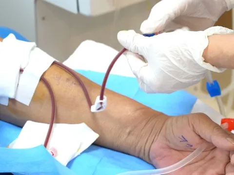 Nhiều người trẻ suy thận do biến chứng từ viêm cầu thận IgA 0