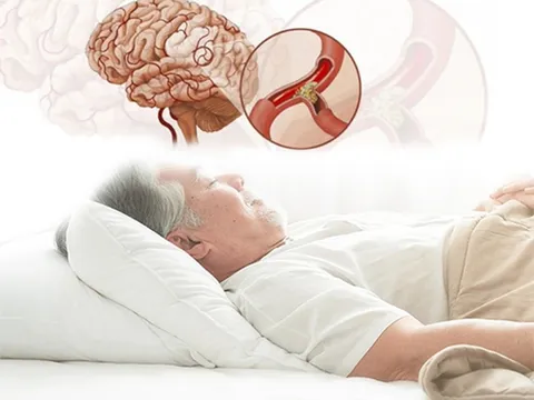 Cảnh báo nguy cơ đột tử do ngủ ngáy kéo dài 0