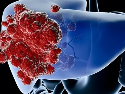 Bất ngờ phát hiện ung thư gan giai đoạn muộn từ 3 dấu hiệu lạ ở bụng