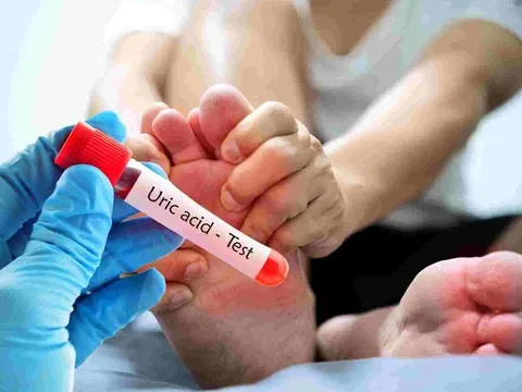 "1 giảm – 2 tăng" giúp kiểm soát acid uric tự nhiên không cần thuốc