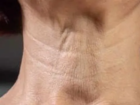 4 bài tập đơn giản xóa nếp nhăn, làm săn chắc vùng cổ tự nhiên tại nhà