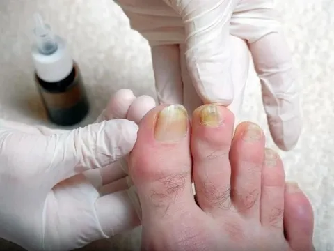 "Soi" chân bắt bệnh: 5 dấu hiệu cho thấy lá gan đang “kiệt sức”, nguy cơ UNG THƯ cận kề