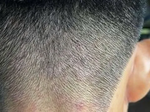 Hiểu đúng về gàu và nấm da đầu – Vì sao càng dùng 'mẹo' dân gian càng nặng?