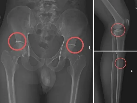 Vụ tự đục gãy xương để chiếm đoạt hơn 6 tỷ đồng tiền bảo hiểm: Bác sĩ thốt lên "quá tàn nhẫn”