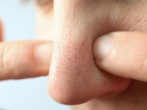 5 loại mặt nạ trị mụn đầu đen từ nguyên liệu nhà bếp giúp da mịn sạch tự nhiên