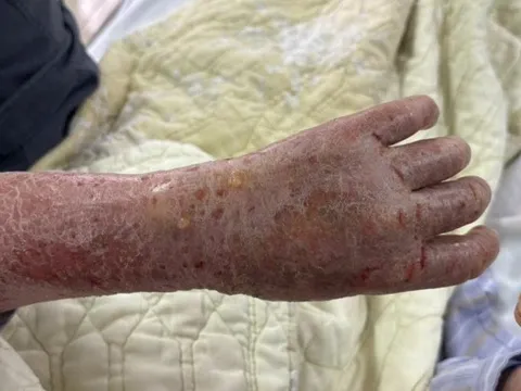 Người phụ nữ bị ngứa dữ dội đến mức “ảo giác có sâu bò”: Nguyên nhân gây sốc từ thói quen nhiều người Việt vẫn làm