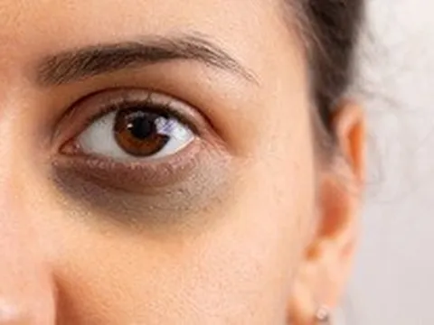 9 loại thực phẩm hỗ trợ sản xuất collagen làm mờ quầng thâm mắt tự nhiên