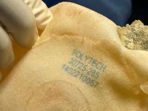 Ưu điểm tháo túi ngực và thay túi ngực, mê mask thanh quản 0