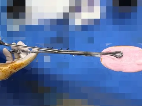 Bé gái đi cấp cứu vì nhét xà phòng vào vùng kín lúc đang tắm