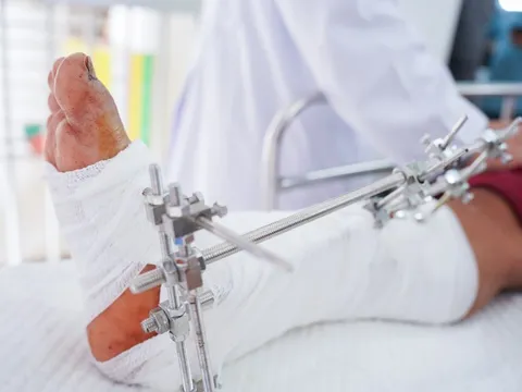 Nối thành công bàn chân của 2 nạn nhân bị máy cắt cỏ chém đứt lìa 0