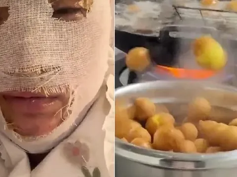 Cô gái suýt biến dạng khuôn mặt khi nấu ăn, cảnh báo 3 thực phẩm dễ "phát nổ" cần chú ý