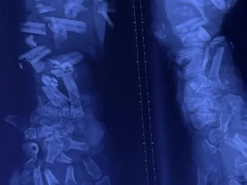 Tai nạn lao động thương tâm: Công nhân 37 tuổi bị máy nghiền vỏ dừa cán nát cánh tay