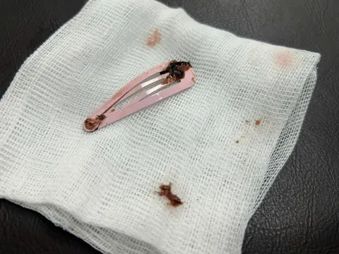 Gắp kẹp tóc dài 7cm khỏi dạ dày bé gái 6 tuổi 0