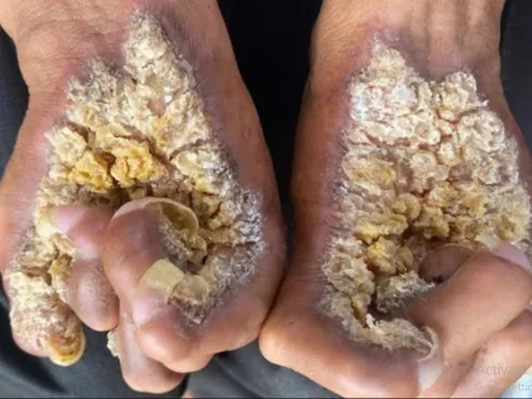 Da xù xì như mọc nấm vì hội chứng lạ 0