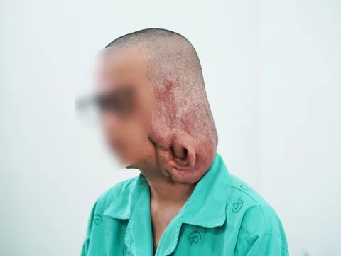 Phẫu thuật cắt bỏ khối u sợi thần kinh gần 1kg gây biến dạng mặt 0