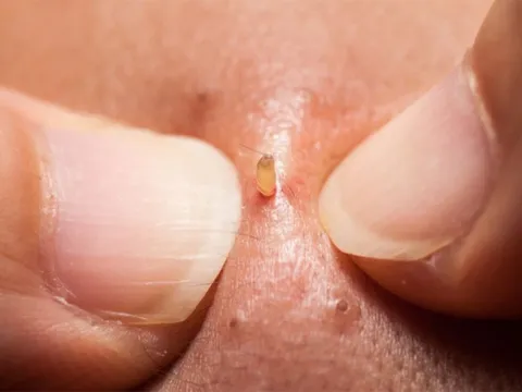 7 lý do nhiều người nghiện xem clip nặn mụn dù trông rất ghê