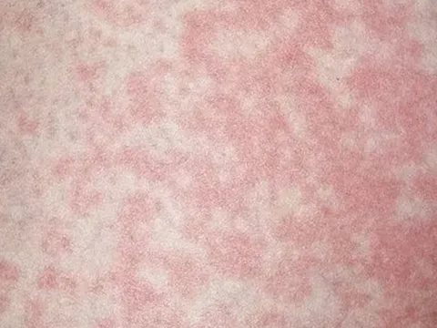 Người đàn ông nhiễm nấm vùng kín vì thói quen nhiều người làm với đồ lót của mình